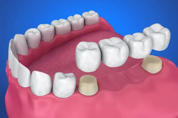 crowns-bridges-veneers-03